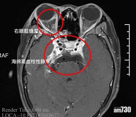 鼻樑 暗瘡